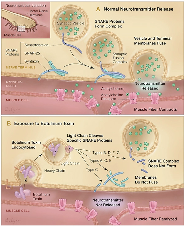 botulinum toxin b)