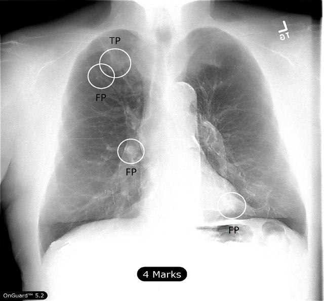 Figure 3: True Positive (TP) and False Positive (FP) CAD Markings