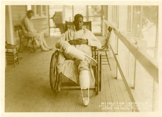 A World War I war 'cripple' wearing temporary pilons, which precede permanent artificial limbs.