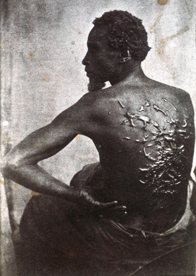 Scars from being whipped as a slave, circa 1863